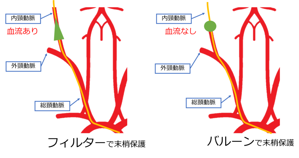 頸動脈ステント留置術には何が関係しますか?