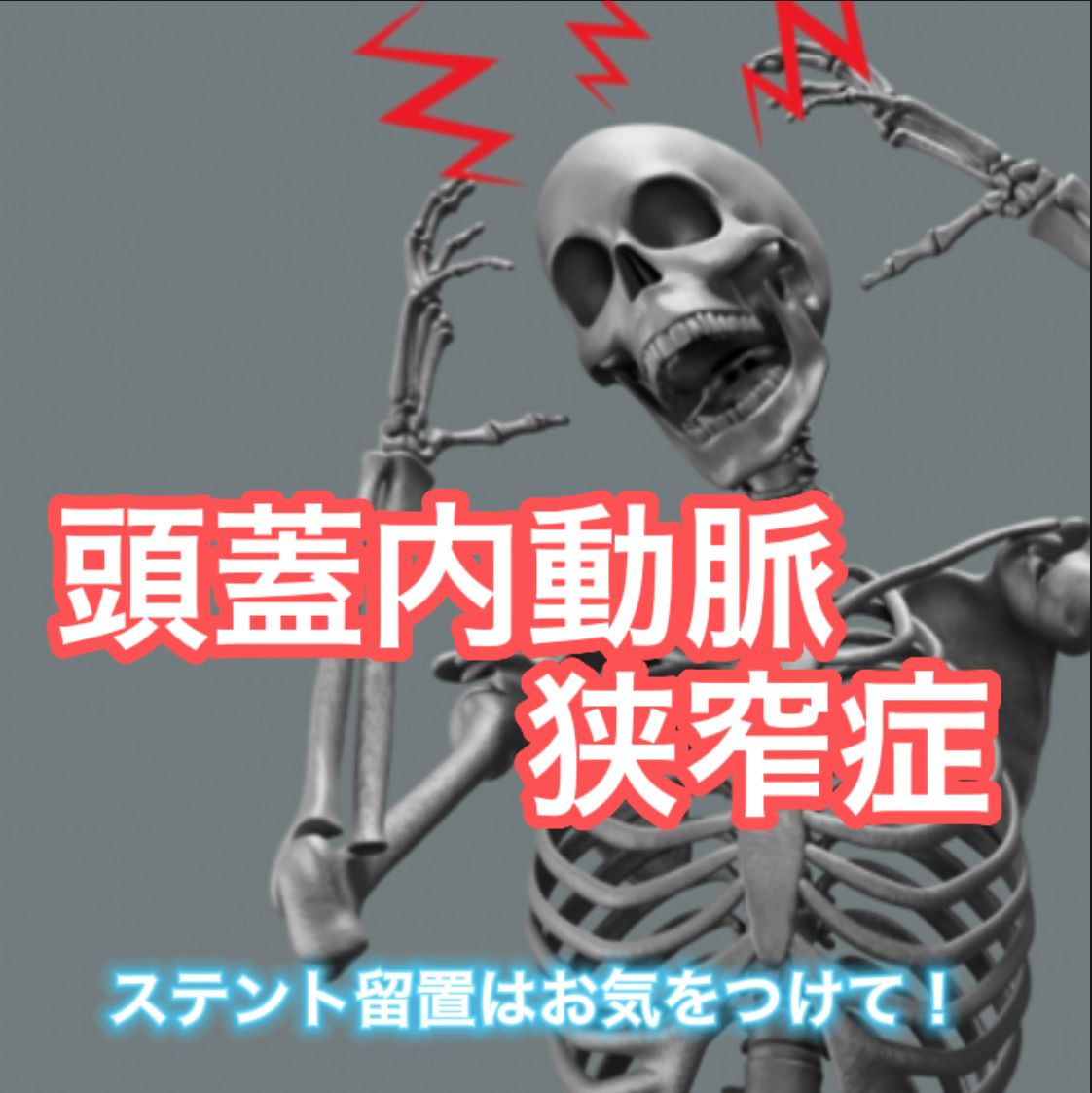 頭蓋内狭窄症（ICAS）の概要と治療 【PTA：経皮的血管形成術